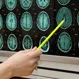 Alzheimer's Disease Quiz